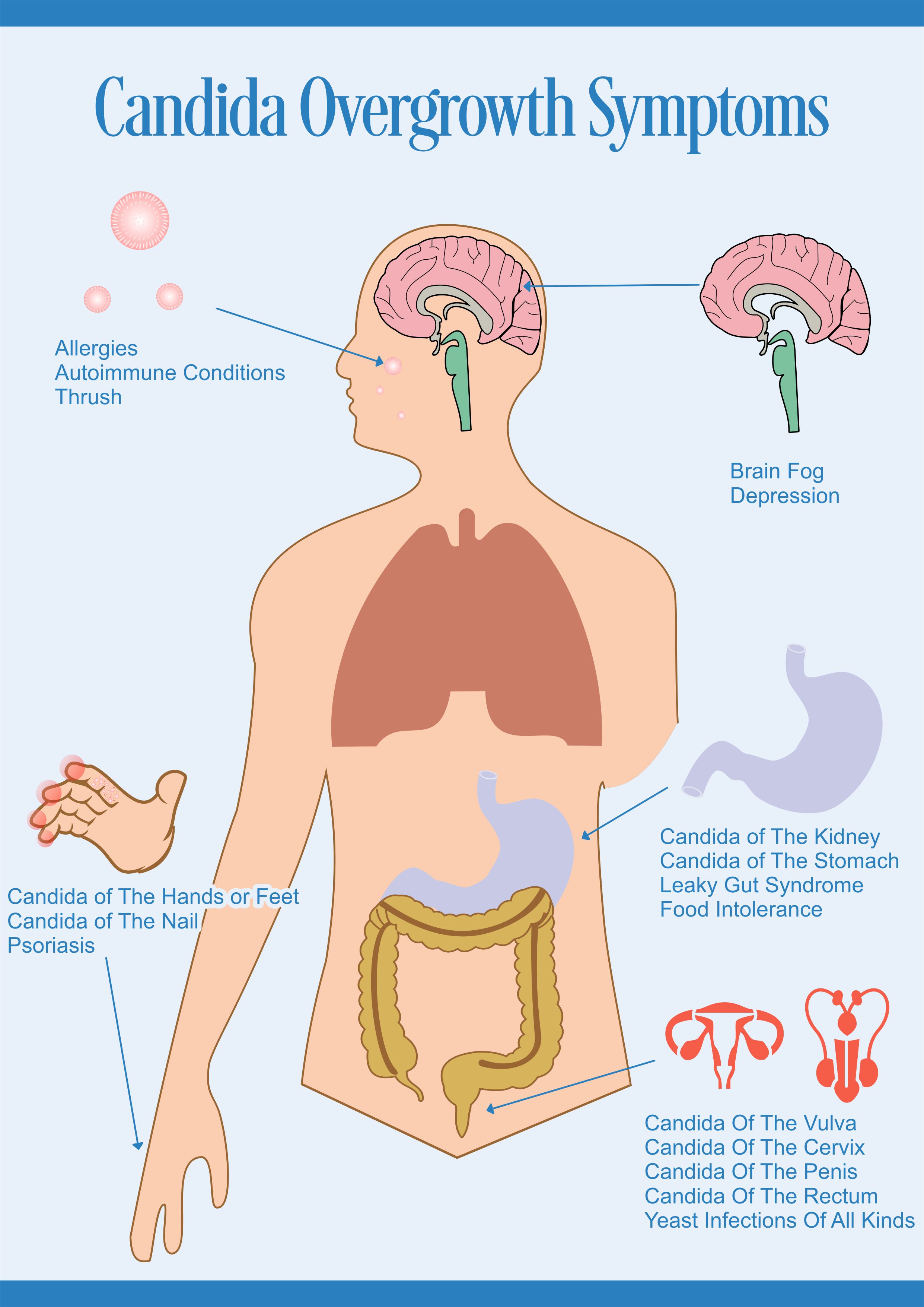 Miliaria - Wikipedia